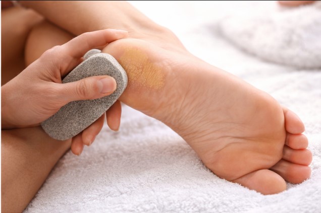 Gently removing softened calluses with a pumice stone