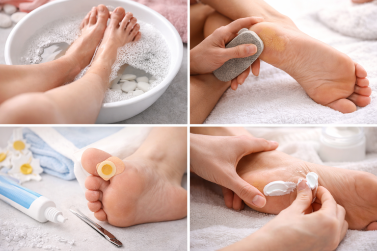 How to get rid of corns and calluses on feet safely at home